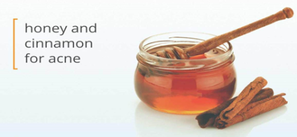 Honey and Cinnamon for acne